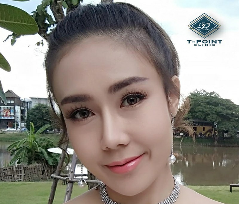 เสริมจมูก เชียงใหม่ ราคาถูก กับคลินิก ที่ไหนดี ? เสริมจมูก เชียงใหม่ ราคาถูก กับคลินิก ที่ไหนดี ?