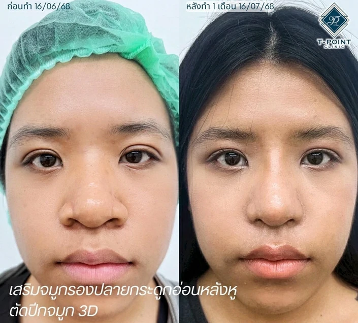 เสริมจมูกเชียงใหม่
