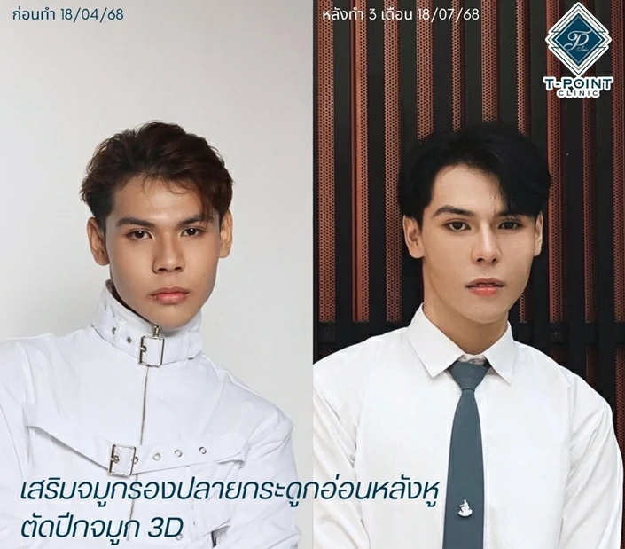 เสริมจมูกเชียงใหม่