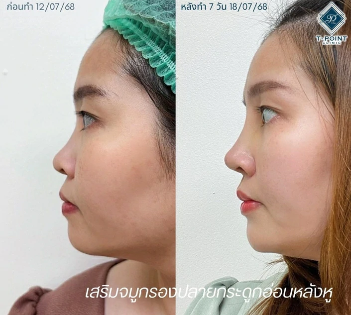 ทำจมูกเชียงใหม่