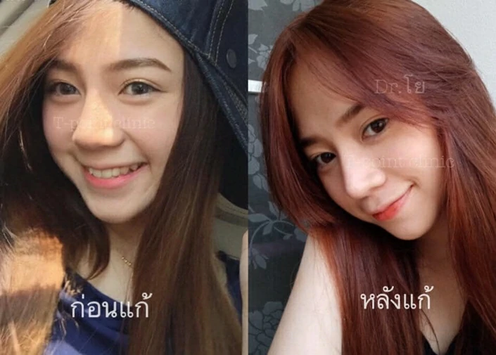แก้จมูกเชียงใหม่