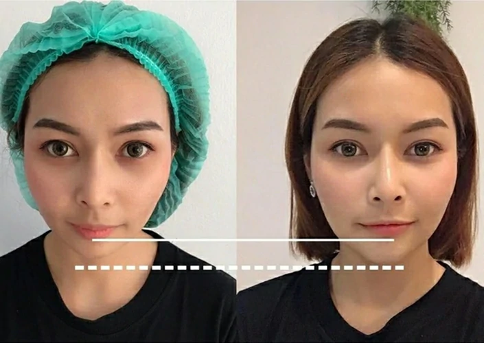 เสริมคาง เชียงใหม่