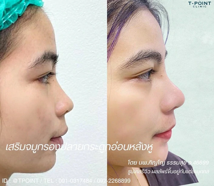 ทำจมูก เชียงใหม่