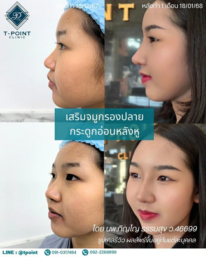 เสริมจมูก เชียงใหม่