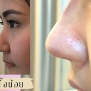 เสริมจมูก เชียงใหม่