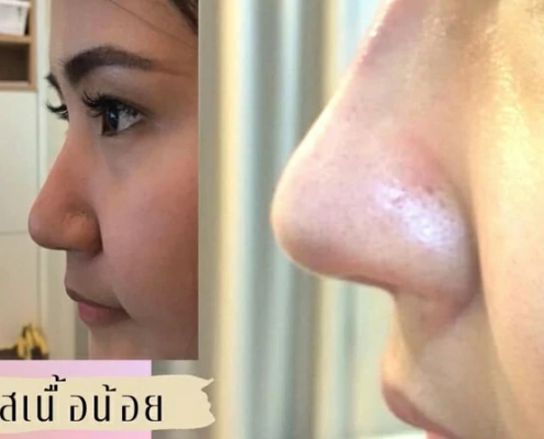 เสริมจมูก เชียงใหม่