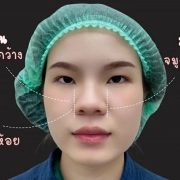 ทำจมูก เชียงใหม่