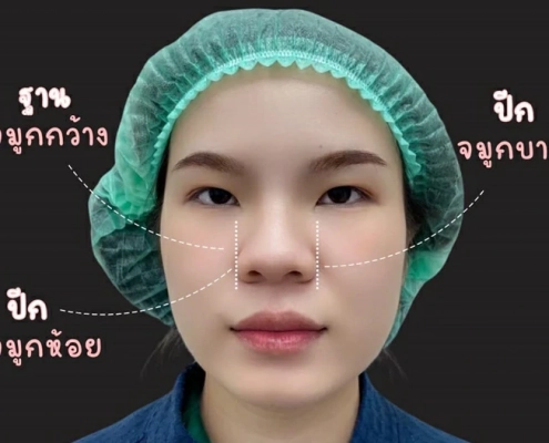 ทำจมูก เชียงใหม่