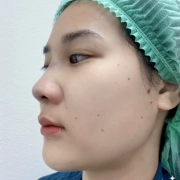 เสริมจมูก เชียงใหม่