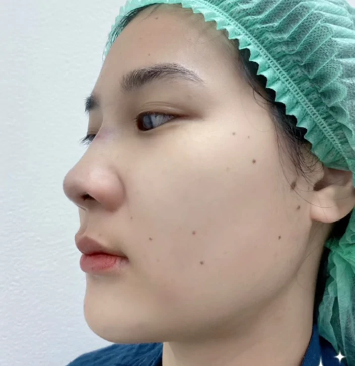 เสริมจมูก เชียงใหม่