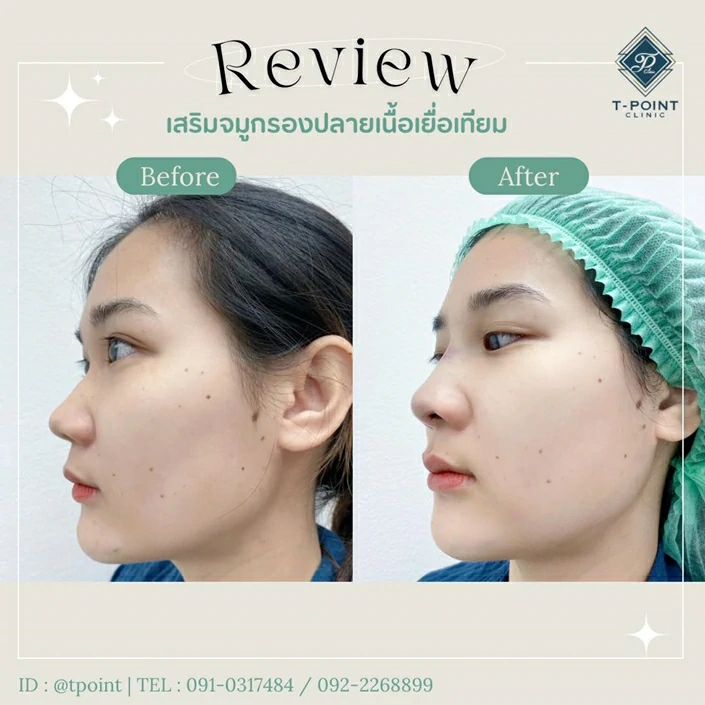 เสริมจมูก เชียงใหม่