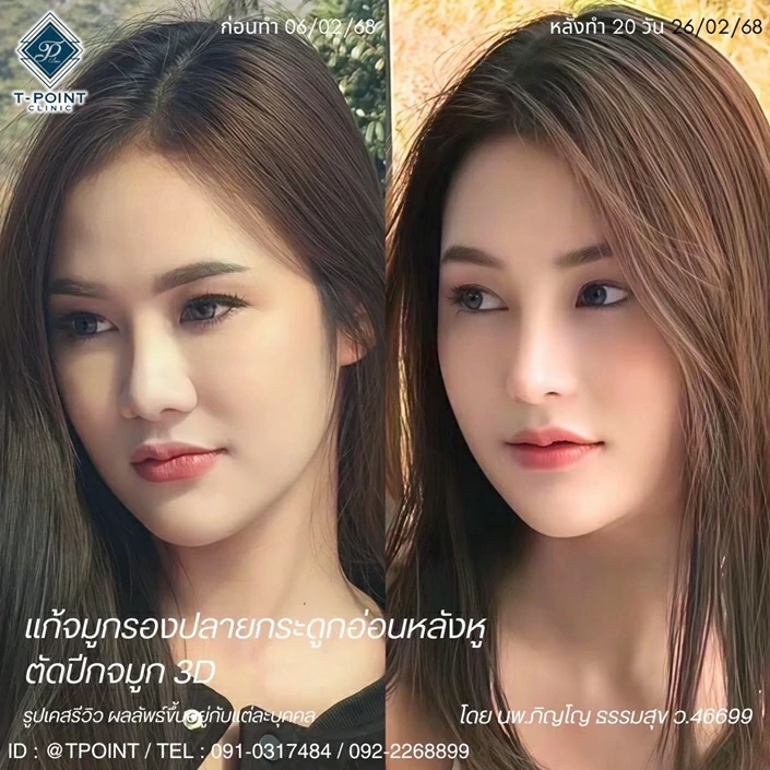 เสริมจมูกเชียงใหม่