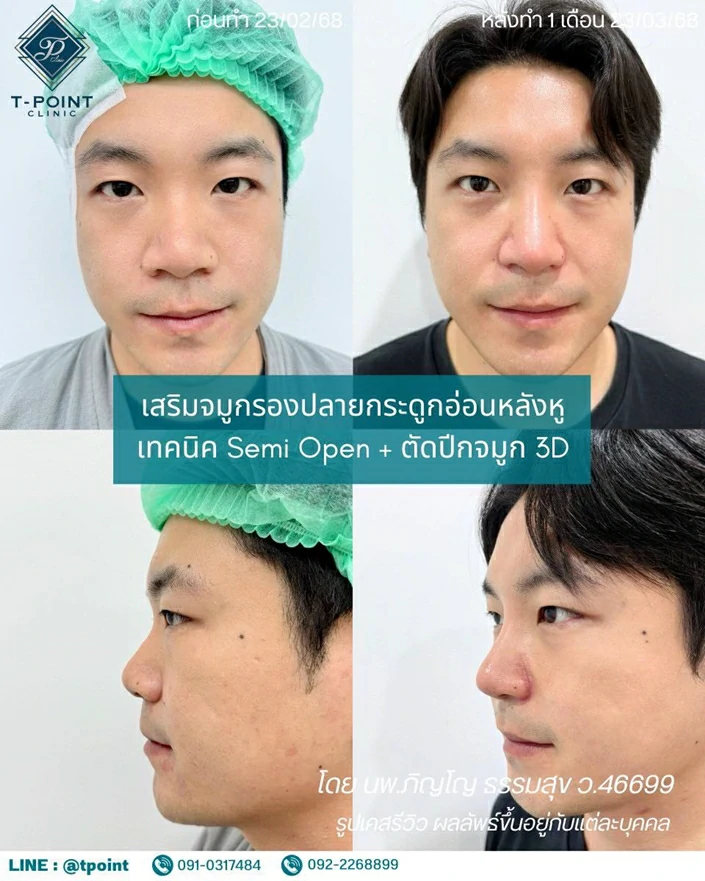 เสริมจมูกเชียงใหม่