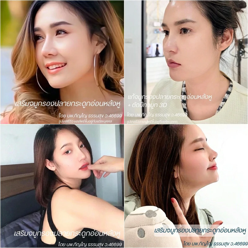 ศัลยกรรมจมูก เชียงใหม่