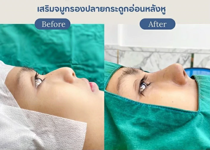 ศัลยกรรมจมูก เชียงใหม่