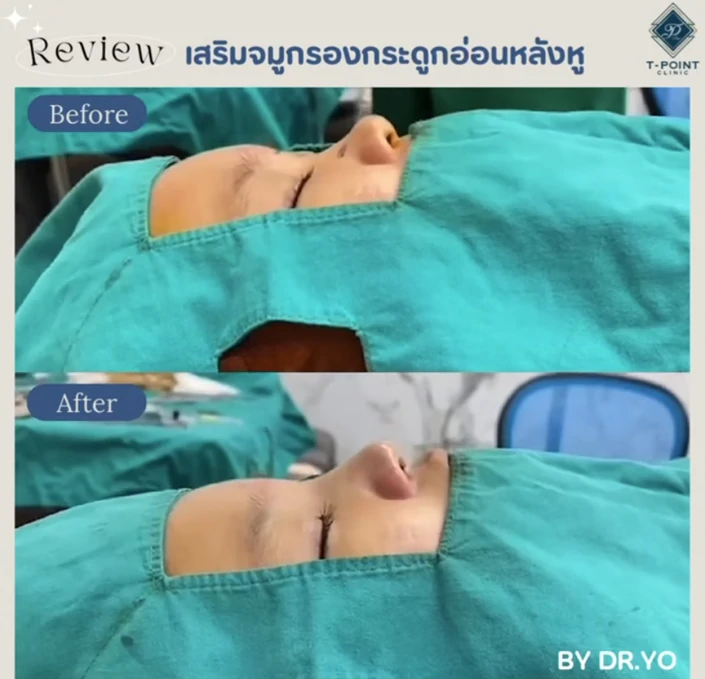 รองปลายด้วยกระดูกอ่อนหลังหู