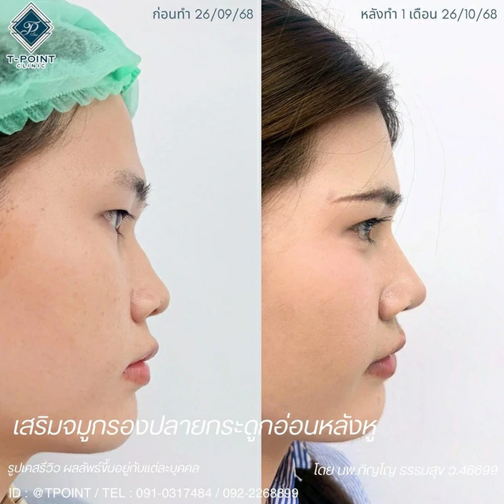 เสริมจมูก