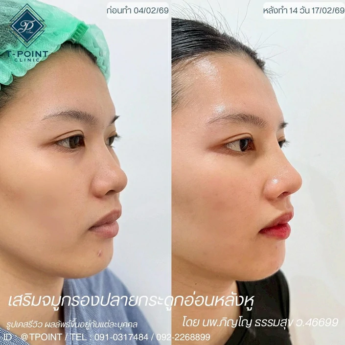 ผลลัพธ์เสริมจมูกที่เชียงใหม่